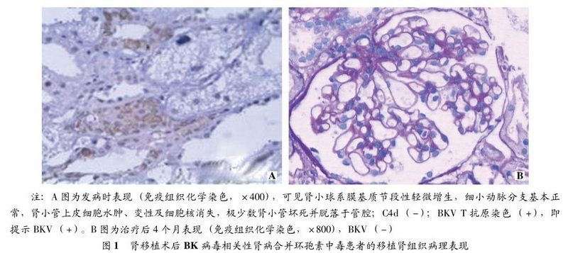 肾移植术后BK病毒相关性肾病合并环孢素中毒1例报告.jpg