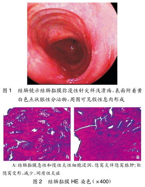 1 肾移植术后溃疡性结肠炎1例并文献复习.jpg