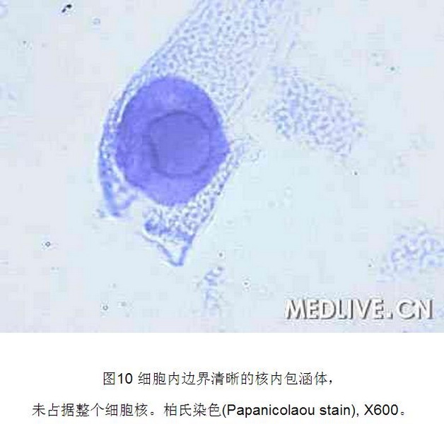 10 肾移植后BK病毒性间质性肾炎1例.jpg