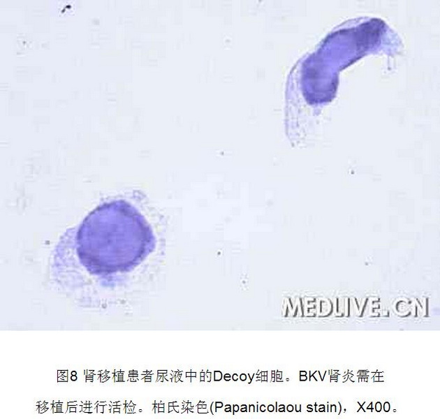 8 肾移植后BK病毒性间质性肾炎1例.jpg