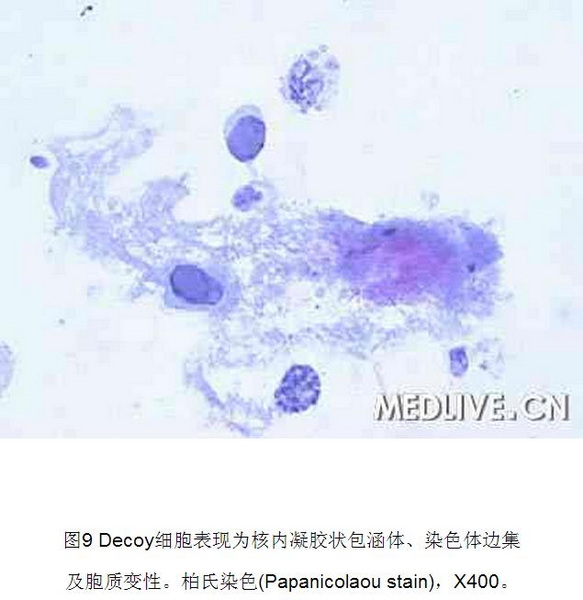 9 肾移植后BK病毒性间质性肾炎1例.jpg