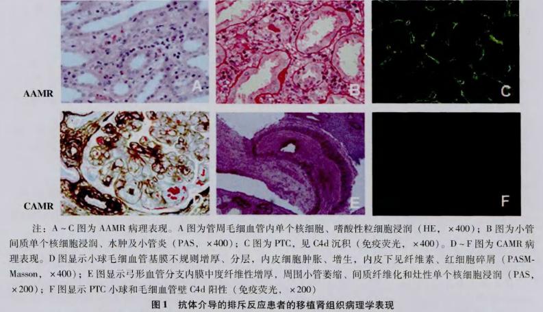 2 肾移植后抗体介导的排斥反应的临床病理特征及个体化免疫治疗.jpg