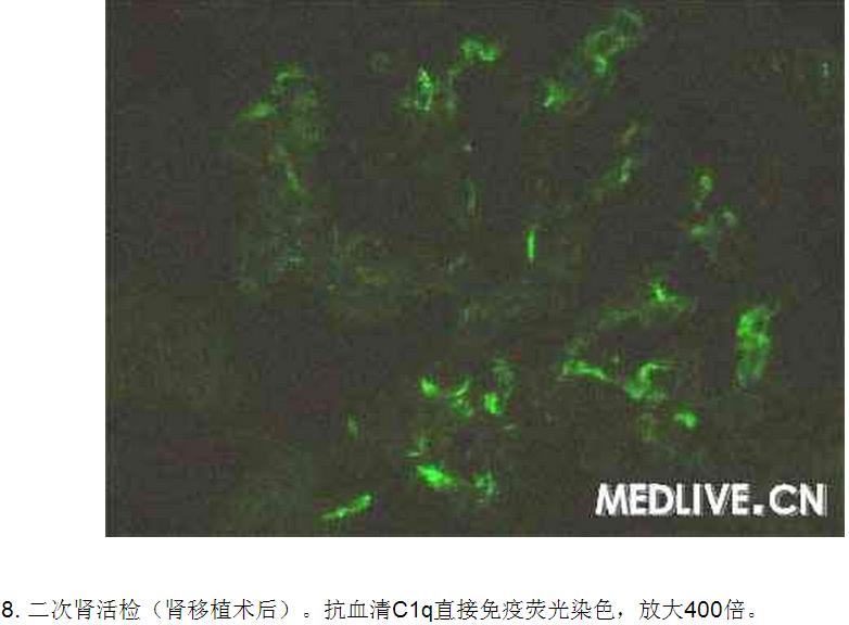 8 病例诊断—肾移植后进行性尿蛋白增加 全身水肿.jpg