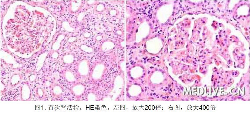 1 病例诊断—肾移植后进行性尿蛋白增加 全身水肿.jpg