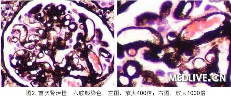 2 病例诊断—肾移植后进行性尿蛋白增加 全身水肿.jpg