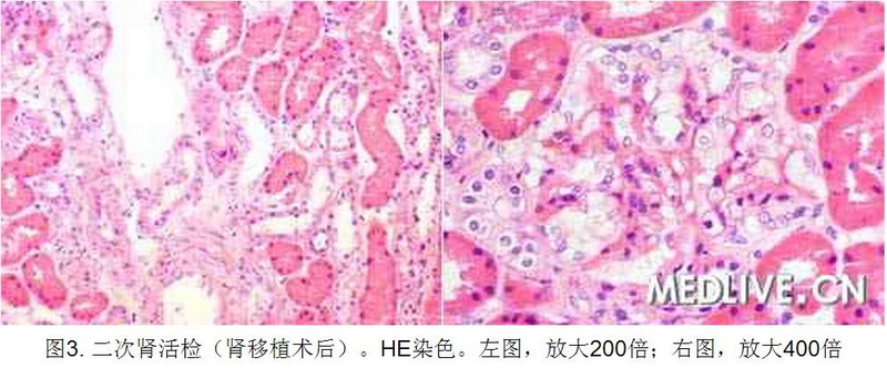3 病例诊断—肾移植后进行性尿蛋白增加 全身水肿.jpg
