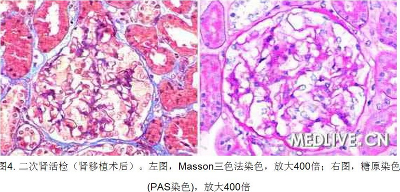 4 病例诊断—肾移植后进行性尿蛋白增加 全身水肿.jpg
