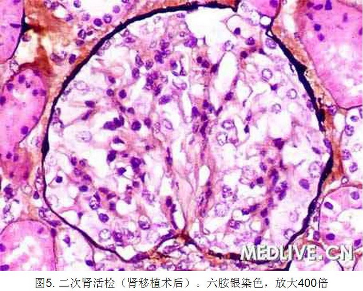 5 病例诊断—肾移植后进行性尿蛋白增加 全身水肿.jpg