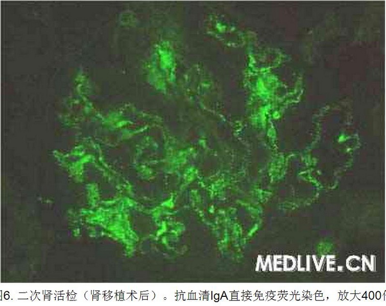6 病例诊断—肾移植后进行性尿蛋白增加 全身水肿.jpg