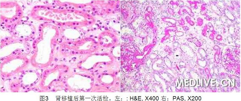 3 病例诊断—肾移植1年后供体肾功能障碍.jpg