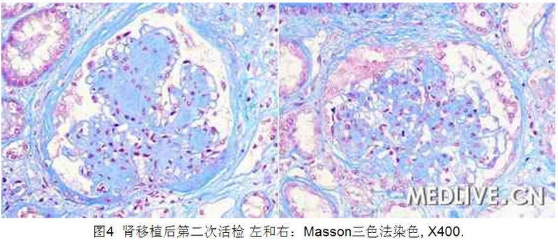4 病例诊断—肾移植1年后供体肾功能障碍.jpg
