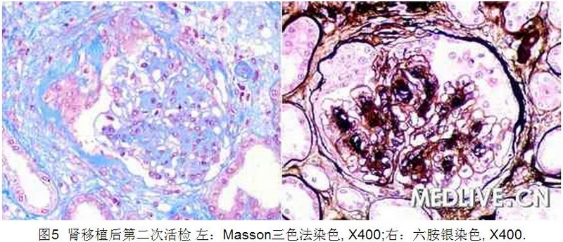 5 病例诊断—肾移植1年后供体肾功能障碍.jpg