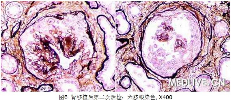 6 病例诊断—肾移植1年后供体肾功能障碍.jpg