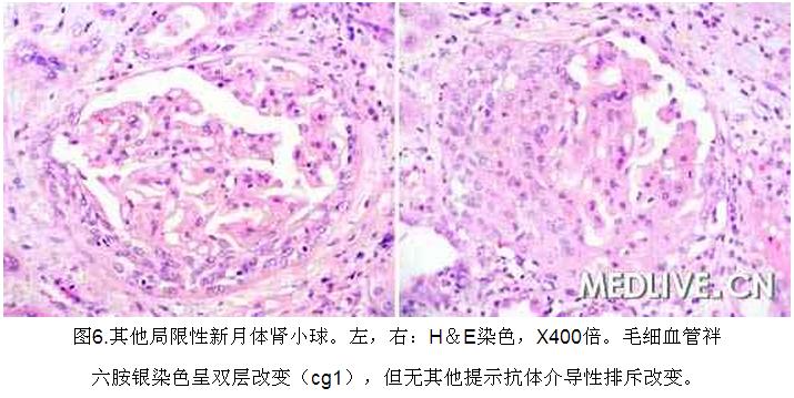 6 病例诊断—肾移植5年后血清肌酐进行性升高.jpg
