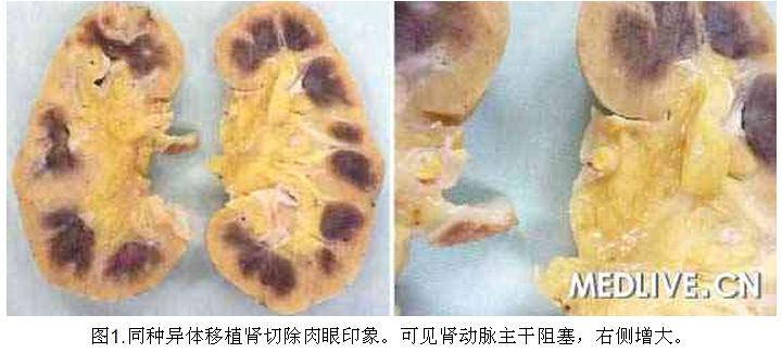 1 病例诊断—肾移植5年后血清肌酐进行性升高.jpg