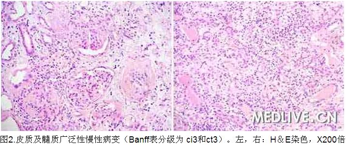 2 病例诊断—肾移植5年后血清肌酐进行性升高.jpg