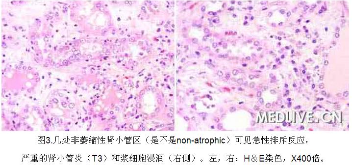 3 病例诊断—肾移植5年后血清肌酐进行性升高.jpg