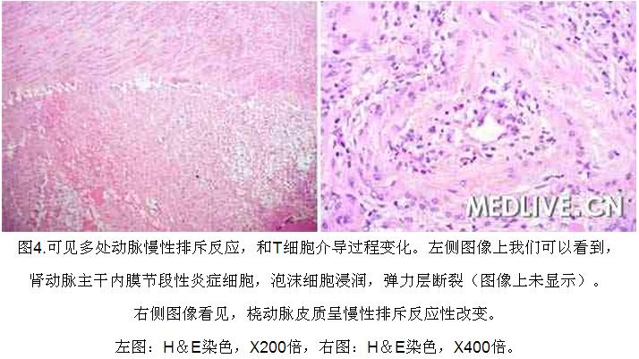 4 病例诊断—肾移植5年后血清肌酐进行性升高.jpg