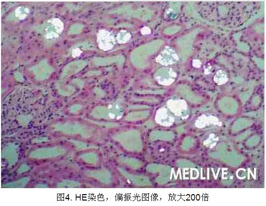 4 病例诊断—肾移植后草酸盐结晶形成.jpg