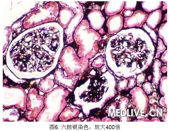 6 病例诊断—肾移植后草酸盐结晶形成.jpg