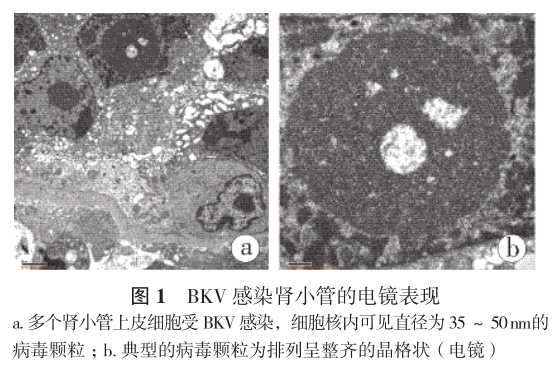 图1 bkv感染肾小管的电镜表现.png