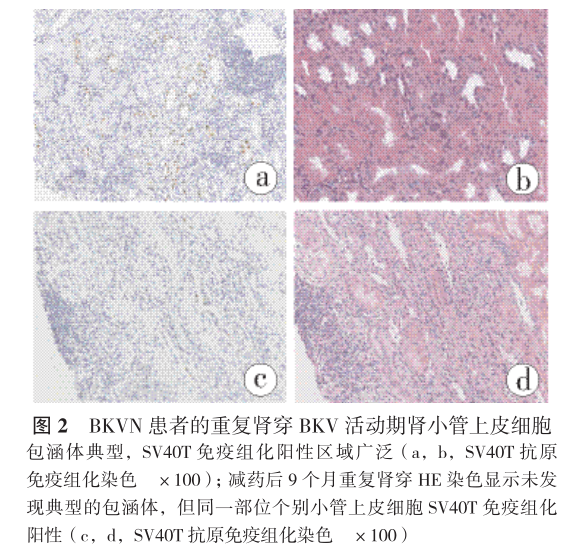 图2 bkvn患者的重复肾穿bkv活动期肾小管上皮细胞.png