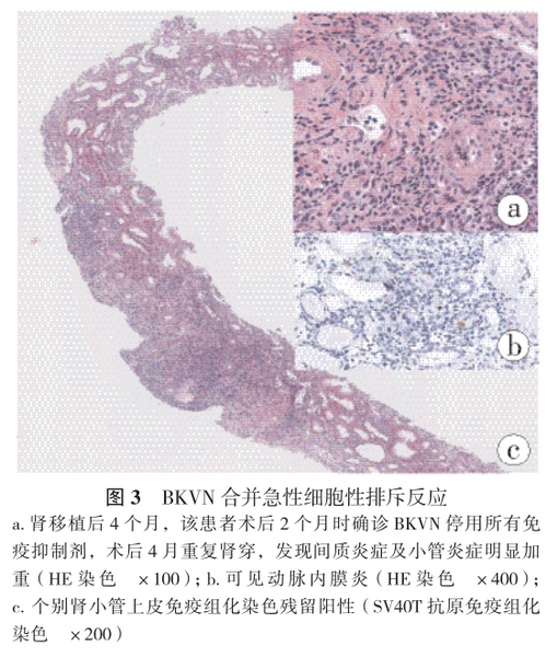 图3 bkvn合并急性细胞性排斥反应.png