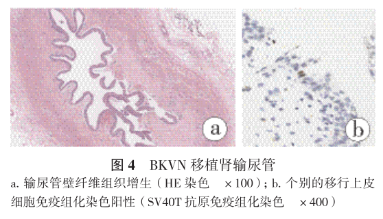 图4 bkvn移植肾输尿管.png