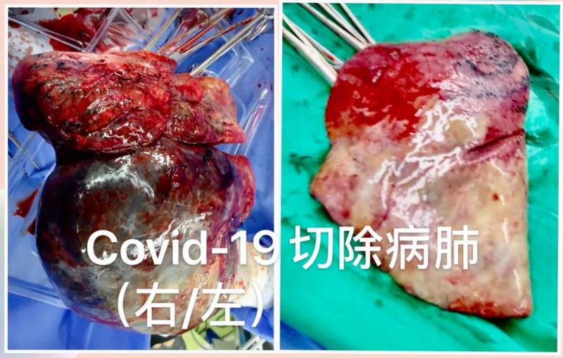 切除的COVID-19病人的病肺.jpg