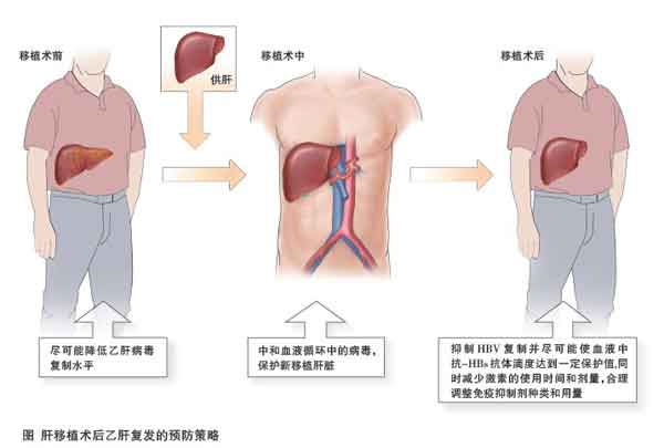 肝移植术后乙肝复发的防治策略.jpg