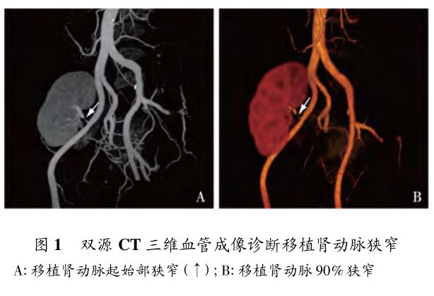 移植肾动脉狭窄的早期诊治策略及疗效评价 图1.jpg