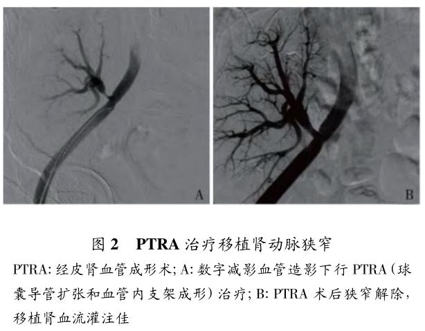 移植肾动脉狭窄的早期诊治策略及疗效评价 图2.jpg