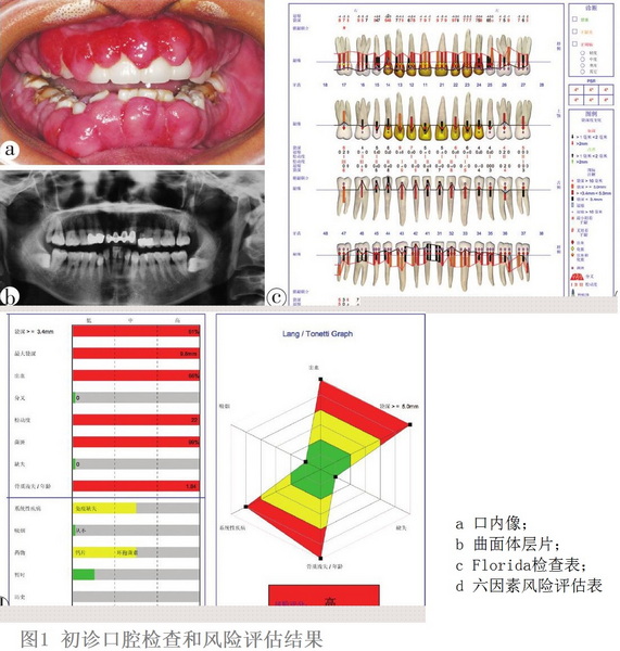 1 肾移植术后药物性牙龈增生牙周序列治疗.jpg