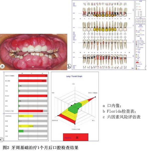 3 图2 肾移植术后药物性牙龈增生牙周序列治疗.jpg