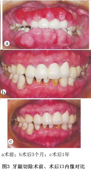 4 图3 肾移植术后药物性牙龈增生牙周序列治疗.jpg