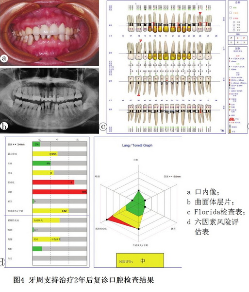 5 图4 肾移植术后药物性牙龈增生牙周序列治疗.jpg