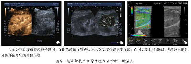 图8 超声新技术在肾移植术后诊断中的应用.png