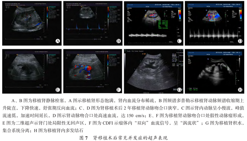 图7 肾移植术后常见并发症的超声表现.png