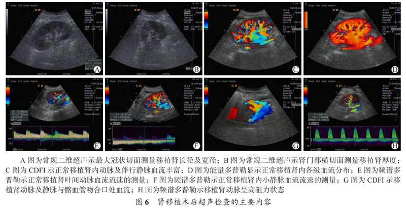 图6 肾移植术后超声检查的主要内容.png