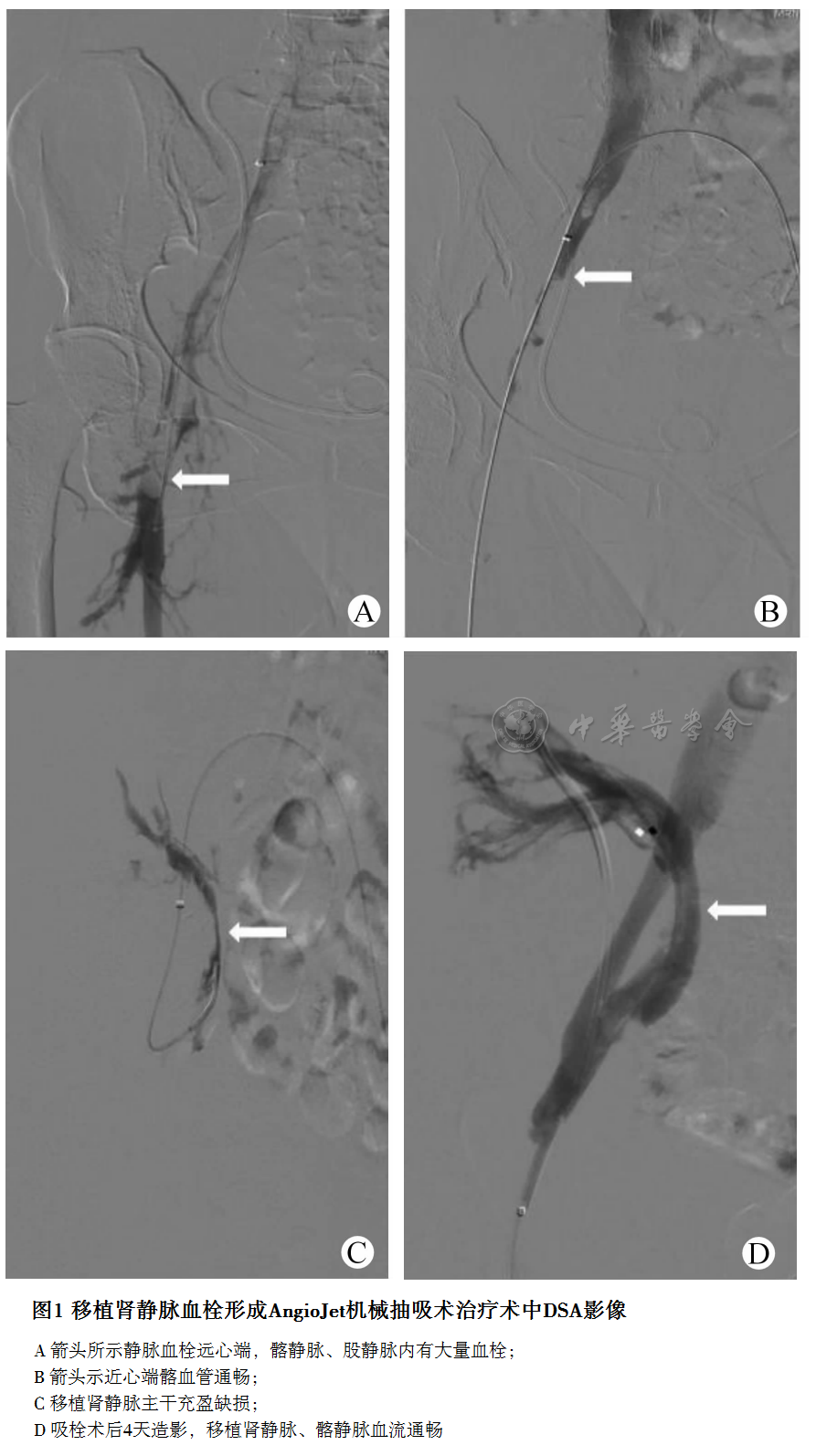 图1 机械抽吸术治疗术中DSA影像.png