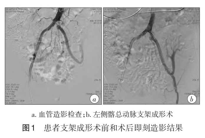 图1 患者支架成形术前和术后即刻造影结果.png