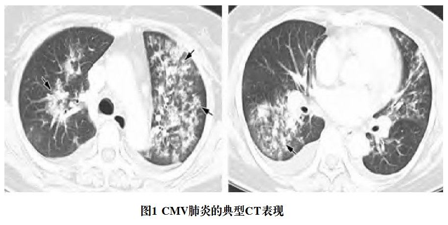 图1 CMV肺炎的典型CT表现.jpg