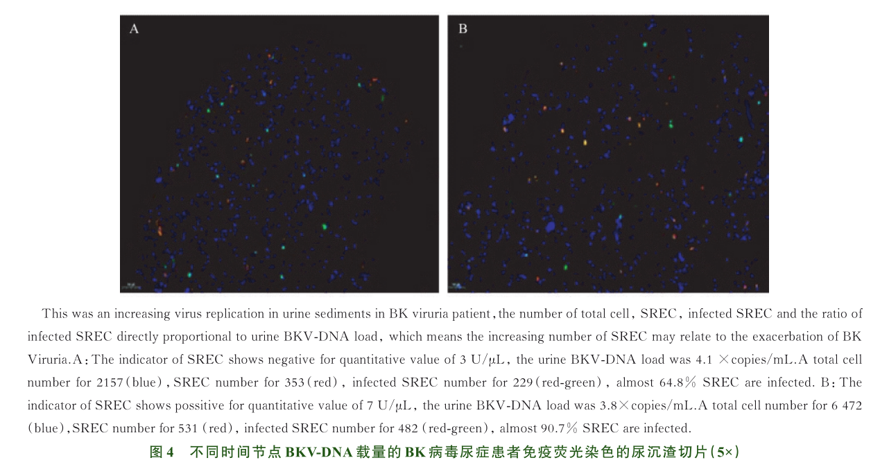 图4 不同时间节点bkv-dna载量的bk病毒尿症患者免疫荧光染色的尿沉渣切片.png