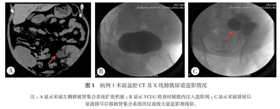 图1 病例1术前盆腔CT及X线膀胱尿道造影情况.jpg