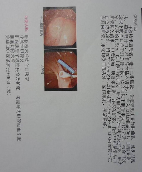 与病友探讨肝移植术后，胆道并发症的治疗经验