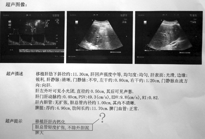 超声结果出来了有点懵！请各位专家和朋友帮忙看看！
