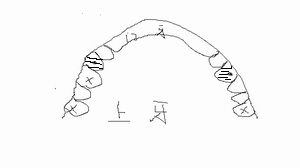 [求助]牙师请教牙医