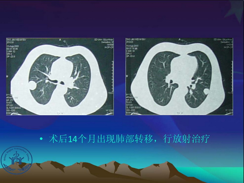 凤凰社肝移植长期生存交流会专家讲座提要