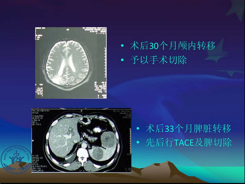 天一中心凤凰社肝移植长期生存交流会专家讲座提要