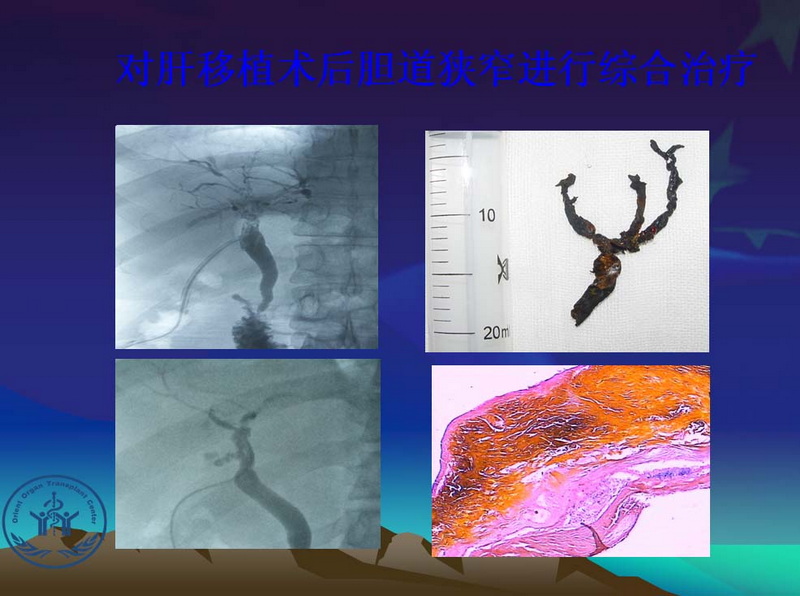 天一中心凤凰社肝移植长期生存交流会专家讲座提要